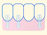 インプラントイメージ